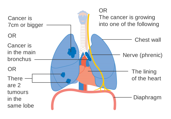 Early Definition and Symptoms of Mesothelioma Early Definition and Symptoms of Mesothelioma